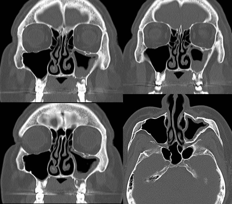 chronic-maxillary-sinusitis-odontogenic-origin